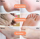 اسپری لایه بردار و ترک پا راکو